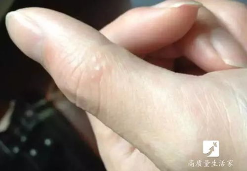 揭秘夏日手部小水疱，成因、真相与有效应对策略